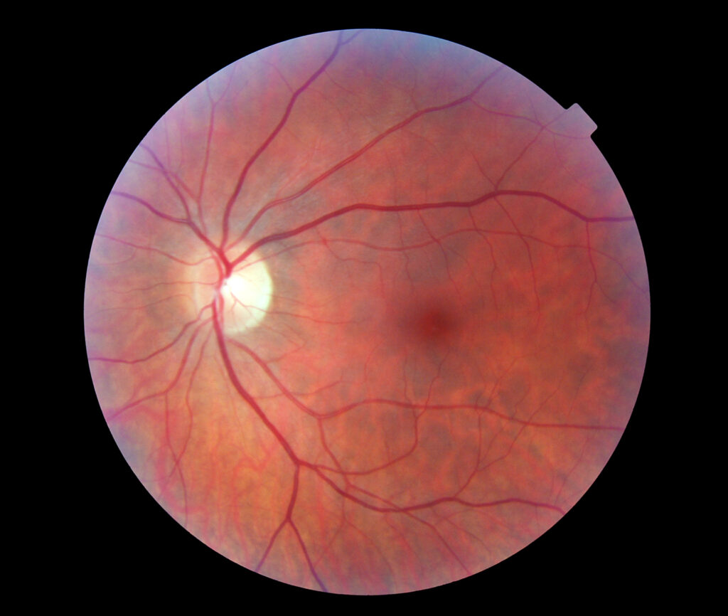 Retina